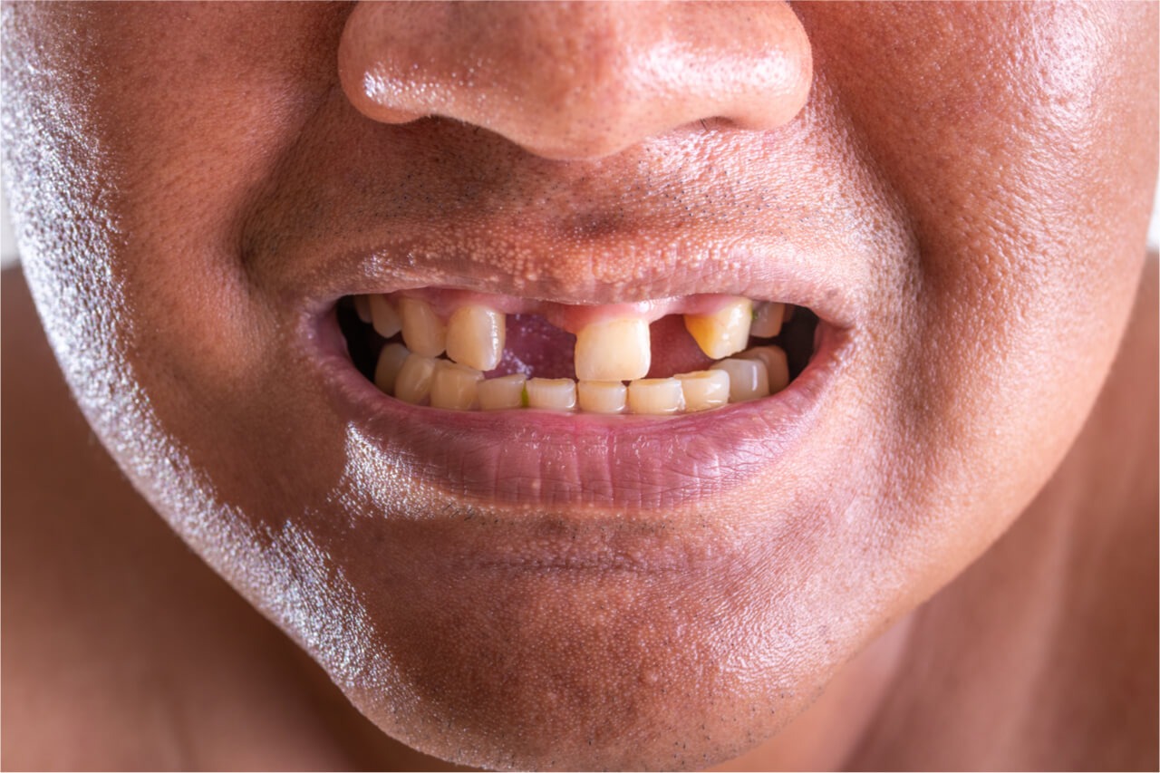 The link between losing your teeth and stroke